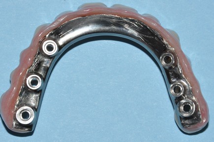 Estructura hibrida vista gingival, Kit Dental