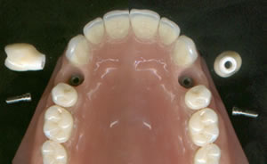 Zircni directa a implant, Kit Dental